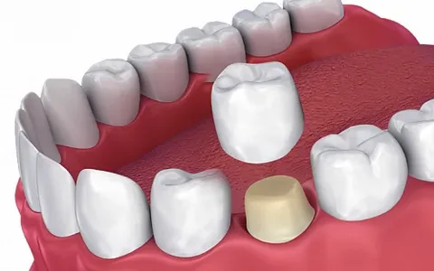 dental crowns